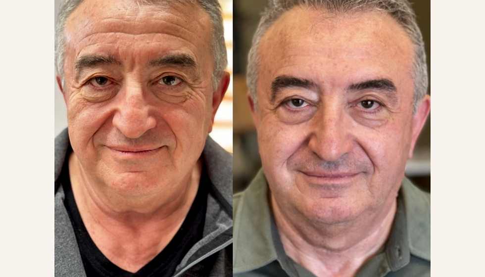 Bukkal masaj öncesi sonrası 6
